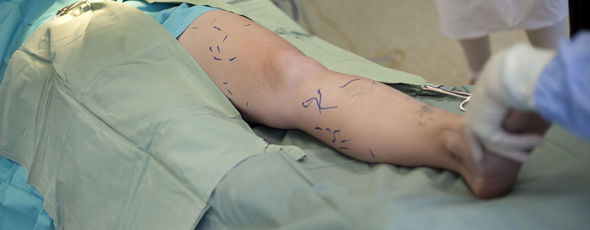 cirugia vascular tratamiento