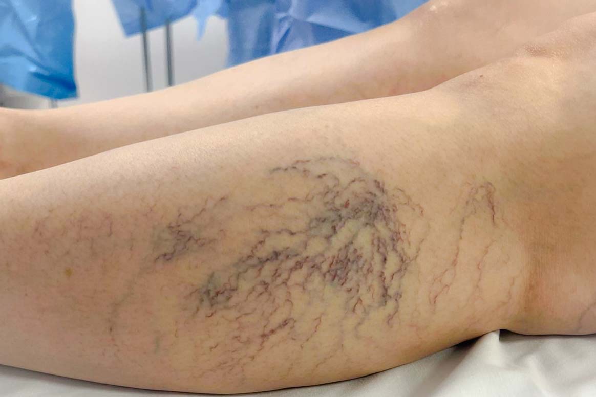 especialistas en varices