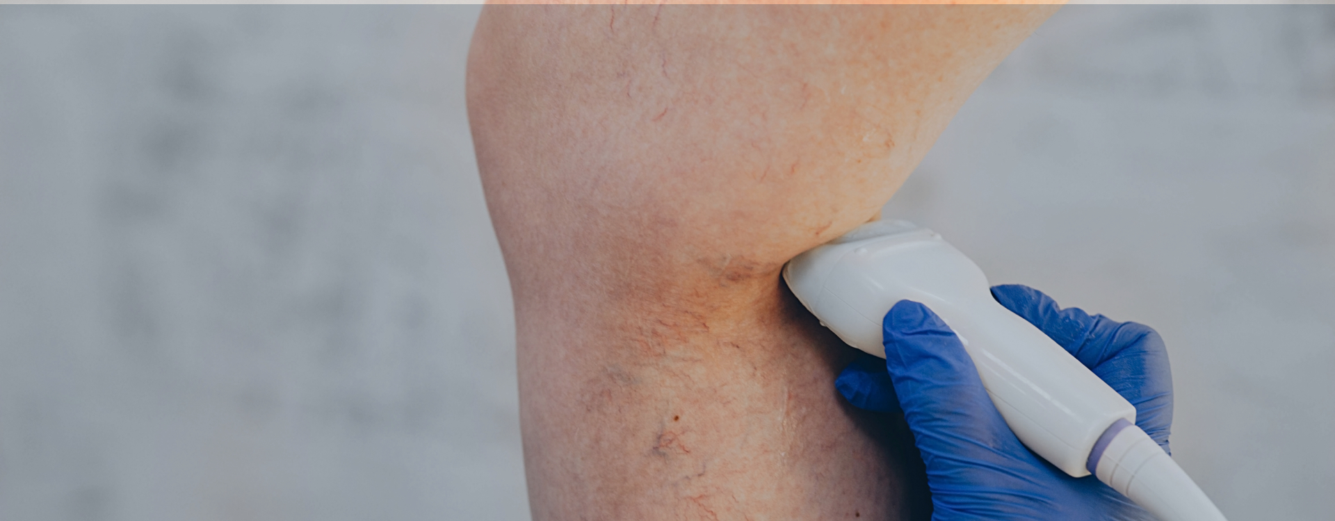 deteccion de trombosis venosa